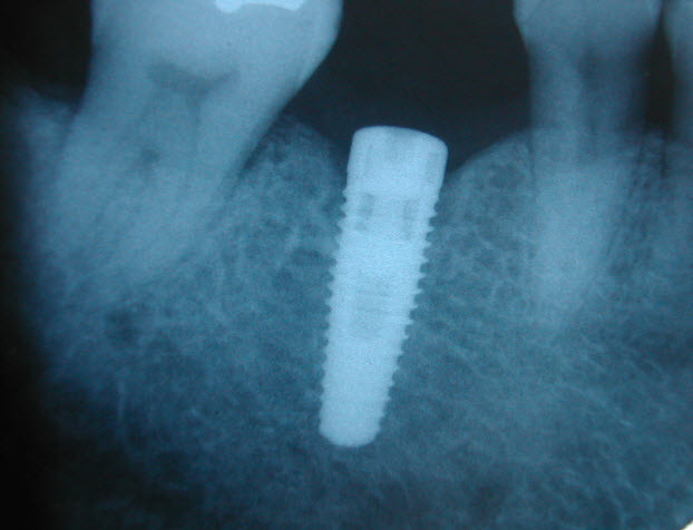 Orangeville Dental Implants