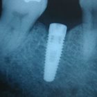 Single Tooth Implant Cost